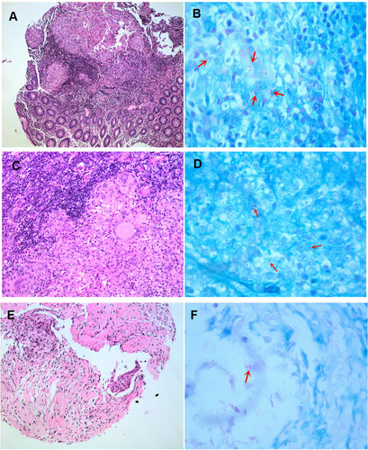 Figure 1 Hematoxylin and eosin stain (H&E) of biopsy specimens. (A) Intestinal biopsy specimen revealed acid-fast bacilli. (B) Intestinal biopsy specimen showed acid-fast bacilli (arrows). (C) Lymph node biopsy specimen revealed acid-fast bacilli. (D) Lymph node biopsy specimen showed acid-fast bacilli (arrows). (E) Bronchial biopsy specimen revealed acid-fast bacilli. (F) Bronchial biopsy specimen showed acid-fast bacilli (arrow). Original magnifications: (A) 100X; (B, D and F) 1000X; (C and E) 200X.