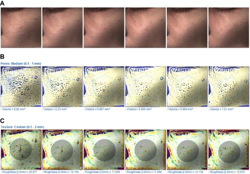 Figure 5 (A) Macroscopic images of the facial skin on the target area of the cheek treated by PDT with RT gel. (B) The volume of the target area of the cheek treated by PDT with RT gel. (C) The roughness index of the target area of the cheek treated by PDT with RT gel, measured by Antera 3D at every evaluation.