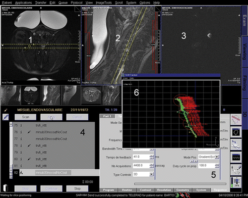 Figure 5. User interface showing (1 and 2) the high-resolution MR images used to position the pig; (3) the off-resonance image used for the magnetic compatibility check and the tracking sequence calibration; (4 and 5) the Siemens sequence and protocol editor; and (6) our custom software showing the real-time position of the bead superimposed on a scale frame. [Color version available online.]