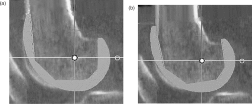 Figure 4. Flexion of component. When the antero-superior apex of the femoral component dug into the anterior cortex of the femur (a), the femoral component was flexed around the TEA to avoid creation of a notch (b).