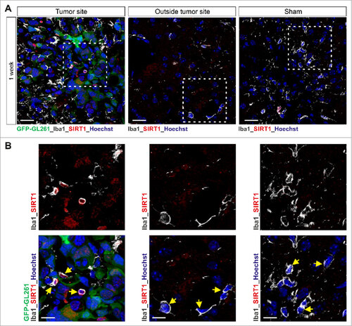 Figure 4. Increased SIRT1 expression is observed in microglia in mouse glioblastoma tumor model. (A and B) Confocal microscopy of tumors formed in mouse brain 1 week after injection of GFP-GL261 cells, with immunostaining for SIRT1 and Iba1 (microglia marker, depicted in white) and Hoechst nuclear counterstain. Scale bars, 20 µm (A), 10 µm (B). Picture for depicted microglia outside the tumor site was taken 6 mm from tumor border. In the depicted images, some microglia cells are pointed out with a yellow arrow head. Data are representative of one independent experiment with three mice.