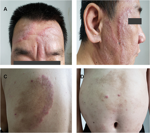 Figure 1 Clinical presentation. Multiple infiltrative red patches and plaques on the face (A and B), abdomen (C) and back (D) with outwardly expanding edges in a circular pattern and tiny pustules distributed in a collar pattern.