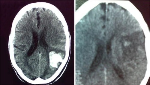 Figure 1 Posttreatment computed tomography scans of two patients with nonsymptomatic hemorrhagic changes.