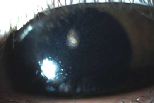 Figure 2.  Cystin crystals in cornea by slit-lamp examination.