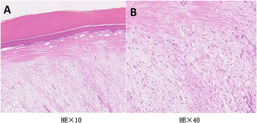 Figure 3 (A) The lesion is mainly concentrated in the dermis and subcutaneous tissue and is seen as a well-defined, non-enveloped tumor (HEx10), (B) The tumor consists of bundles of short spindle, ovoid, and stellate shapes arranged in a fascicular pattern with a high number of branching small to medium-sized thin-walled blood vessels. Large deposits of mucus-like material and scattered mast cells were seen in the tumor tissue. There was no obvious heterogeneity of tumor cells (HEx40).