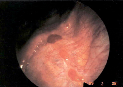 Figure 5. Red–pink endometriosis.Reprinted from Citation[122].
