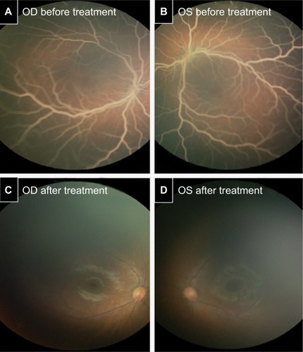 Figure 2 Lipemia retinalis before and after treatment. Fundus examination disclosed bilateral whitish optic discs, diffuse creamy retinal vessels in the peripheral and posterior pole OD (A), OS (B), and salmon-pink retina that were identified as signs of severe lipemia retinalis before treatment. Fundus examination depicted complete bilateral resolution of lipemic retinal vessel disease OD (C), OS (D) after treatment.