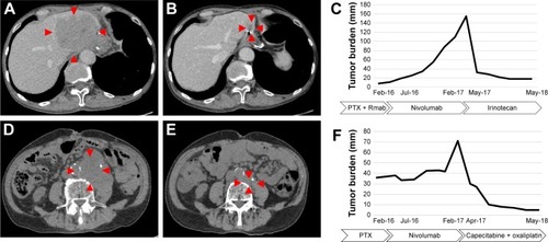 Figure 3 CT imaging and clinical course of the hyper-response in subsequent therapy.