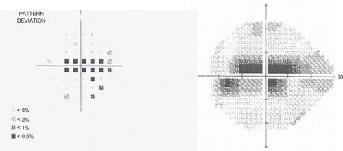 Figure 1 Humphrey visual field testing showing a dense left cecocentral scotoma.