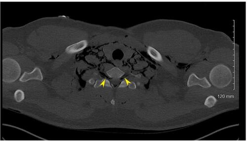 Figure 3 CT imaging demonstrating dissection of fascial planes in neck and invasion of trapped air into the spinal canal (yellow arrows) via intervertebral foramen.