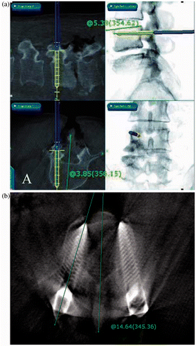 Figure 2. (a) Recorded navigation image and measured SAA and SAS of virtual screw location. (b) Second cb-CT scan image after screw insertion, and measured SAA of actual screw location