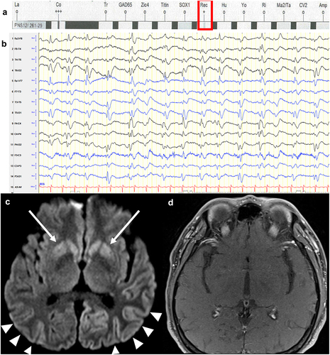 Figure 1. Neuroimages, electroencephalographic findings and paraneoplastic panel of the subject. (A) Serum paraneoplastic panel showed a positive band in anti-recoverin autoantibody region. (B) Electroencephalography showing nearly continuous generalized quasiperiodic sharp slow or sharp-and slow waves at 1–2 Hz, 50–100 uV, with emphasis in posterior head areas. (C-D) Axial view of brain magnetic resonance imaging diffusion weighted imaging showing hyperintensity over bilateral parieto-temporo-occipital lobes (arrowheads) and bilateral putamen and caudate nuclei (arrow), but no contrast enhancement in T1-weighted image.
