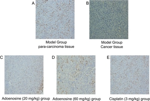 Figure 2 Effects of Ado on RhoGDI2 expression in subcutaneous xenografts in nude mice detected by IHC. A: Para-carcinoma of Model Group. B: Cancer tissue of Model Group. C: Ado (20 mg/kg) group; D: Ado (60 mg/kg) group; E: cisplatin (3 mg/kg).