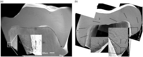 Figure 7. Total fracture. Two typical fractures dividing the crown in two parts from the mesial to the distal side. (a) A thin-walled crown with a distinct crack as the initiating flaw. (b) A thick-walled crown with fracture origin in a small defect on the outer wall, near the crown margin.