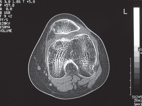 Figure 3. Postoperative computed tomography demonstrating no malalignment of the patella and improvement of sulcus angle from 170° to 140°.