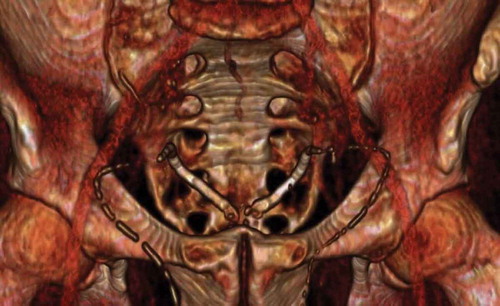 Figure 3. Prior 3D CT reconstruction image of abdomen and pelvis showing similar bilateral vas deferens calcification