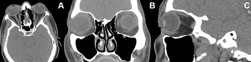 Figure 1 CT scans of the orbit, paranasal sinuses, and basal part of brain images initially obtained. (A) Axial Scan. (B) Coronal Scan. (C) Sagittal scan. It should be noted that cranial and brain scans were not obtained.