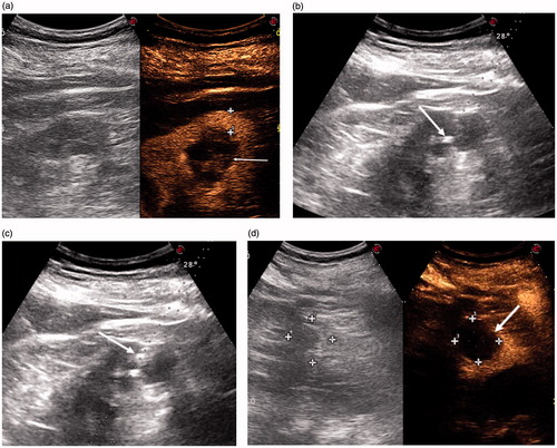 Figure 1. (a) CEUS scan showing a Bosniak III renal cyst cytologically proven to be RCC (arrow): 11.5 mm of renal parenchyma had to be passed through to reach the cyst (cross-shaped markers). (b) US scan showing the tip of a 21-G needle inside the BosnIak III cyst (arrow). (c) The steam produced by LA spreading inside the Bosniak III cyst (arrow). (d) Post-procedural CEUS scan showing a non-enhancing zone completely covering the Bosniak III cyst.