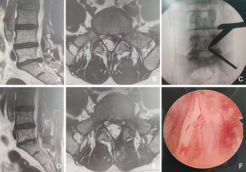 Figure 1 Male, 34 years old, L5/S1 lumbar disc herniation. (A) Preoperative sagittal MR image showed L5/S1 lumbar disc herniation; (B) Preoperative axial MR image showed herniated lumbar disc compressed nerve root and dural sac; (C) Intraoperative fluoroscopic confirmation of metal rods; (D) Postoperative sagittal MR image revealed the complete decompression of the spinal canal; (E) Postoperative axial MR image showed the complete removal of herniated disc and bony fragment; (F) Intraoperative image after complete neural decompression.