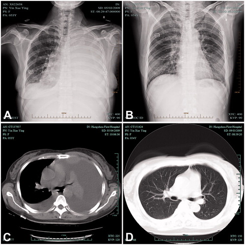 Figure 5. A case of a 53-year-old female with MPE received IPHC. (A and C) A posteroanterior chest radiograph and CT showed a large pleural effusion on the left; (B) Pleural fluid was completed disappeared 2 months after IPHC confirmed by chest radiograph; (D) No pleural fluid re-accumulated 6 months after IPHC confirmed by CT. IPHC intrapleural perfusion with hyperthermic chemotherapy; CT computed tomography.