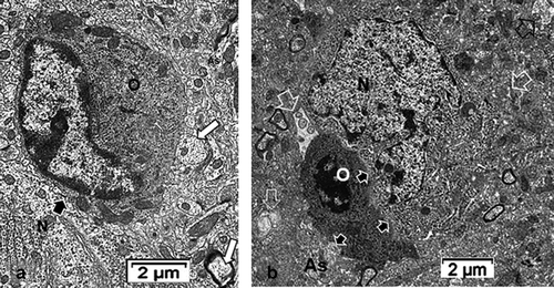 Figure 6. Hyponatremic [HN] satellite oligodendrocytes. Either electron dense cytoplasm with a showed topologic change of the oligodendrocyte nu cleus in A. and B as a lesser size section. Oligodendrocytes maintain junctional complex (black arrows) with adjacent neurons (N), recognized with large Golgi. Axonal myelinated profiles of diverse orientations are associated with oligodendrocytes (white arrows) in A; As: Astrocyte edge. Numerous small and enlarged intercellular neuropil spaces are found near each oligodendrocyte extensions in B (open white arrows in B)