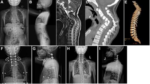 Figure 2 A female patient of 3 years old with C4–T4 vertebral tuberculosis and kyphosis. One-stage posterior approach internal fixation orthopedics was conducted followed by two-stage anterior approach lesion removal with additional bone grafting. (A and B) The preoperative whole spine frontal and lateral x-ray showed obvious C4–T4 kyphosis. (C) The preoperative MRI showed destruction of C4~T4 vertebral body and intervertebral disc, with paravertebral abscess formation and change in the intervertebral disc signal. (D and E) The preoperative CT and sagittal 3D reco nstruction suggested C4-T4 multiple arch bone destruction with C6 vertebral body collapse. (F and G) The whole spine frontal and lateral x-ray after the staged posterior-anterior combined surgery showed a good position of the internal fixation. (H and I) The whole spine frontal and lateral x-ray six year after surgery showed good internal fixation and complete osseous fusion.