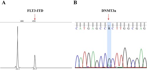 Figure 3. (A) and (B) Gene mutation analysis of FLT3 and DNMT3A in the skin via next-generation sequencing; the results were the same as those for AML cells with mutations in the bone marrow. (Complementary image) The infiltrated inflammatory cells were mainly composed of neutrophils in the dermis layer (hematoxylin-eosin, original magnification x400).