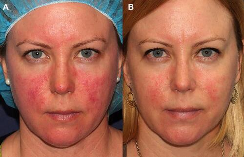 Figure 3 Before (A) and after (B) one treatment with IPL for rosacea. Figure courtesy of Dr. Goldman.