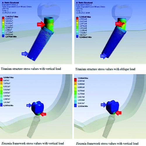 Figure 4. Stress analysis of the angled implant-supported crown.