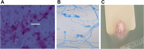 Figure 3 (A) microscopic morphology of Talaromyces marneffei in brain mass (Giemsa stain). The white arrow indicates the presence of Talaromyces marneffei; (B)microscopic morphology of Talaromyces marneffei in brain mass culture (lectophenol cotton blue stain); (C) Results of 6 days culture on SDA medium showed the Talaromyces marneffei.