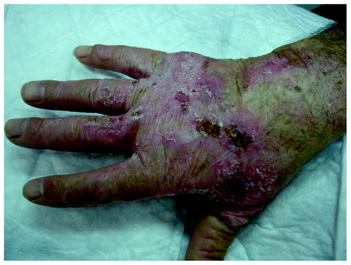 Figure 3. Histologically confirmed Bowen’s disease at right dorsal hand of an elderly patient existing for many years with a recently growing histologically confirmed Bowen’s carcinoma at the base of the thumb.