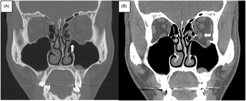 Figure 1. Bone window setting (A) and soft-tissue window setting (B) as seen in preoperative computed tomography image. The bone window setting showed that the inferior orbital wall was fractured like a swinging door (A, white arrow), and the soft-tissue window setting showed the dislocation of the inferior rectus muscle (B, white arrow).