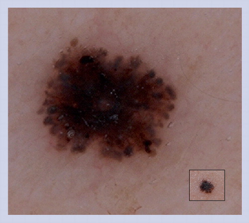 Figure 12. Spitz nevus.The starburst pattern is the most common pattern manifest by typical pigmented Spitz nevi.