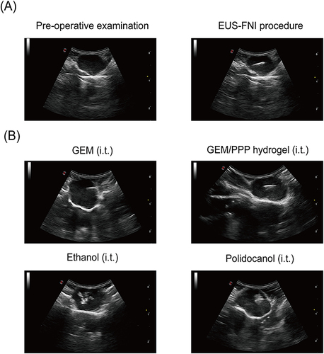 Figure 6 Representative images of EUS-FNI. (A) The procedure of real-time EUS-FNI. (B) Ultrasonographic images of different formulations during procedure. GEM solution injection resulted in rapid diffusion of a hyperechoic substance throughout the tumor mass. GEM/PPP hydrogel injection produced confined, layered hyperechoic matter near the needle tip. Ethanol injection generated irregularly shaped hyperechoic regions. Polidocanol injection created a limited, spherical hyperechoic area surrounding the needle tip.