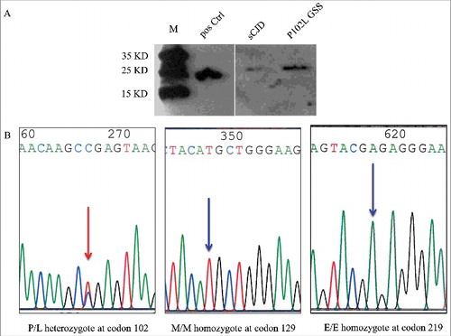 Figure 3. Western blot for CSF 14-3-3 and PRNP gene sequencing. A. Western blot. The tested CSF samples were separated in 12% SDS-PAGE and immunobloted with 14-3-3 specific polyclonal antibody. Positive Ctrl: 10% goat brain homogenate; M: molecular weight; sCJD: CSF sample of a sCJD case; P102L GSS: CSF sample of the case in this study. B. Graphic presentation of the sequencing analysis of PRNP. A missense mutation at codon 102 (CCG to CTG) causing the substitution of Pro (P) to Leu (L) (left panel), Met (M) homozygote at codon 129 (middle panel) and Glu (E) homozygote at codon 219 (right panel).