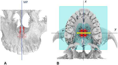 Figure 14 MSE initial default position. (A) Parallelism between the micro-implants and the midsagittal plane (MP) and nasal septum. (B) MSE expansion force vector (yellow arrow) positioned perpendicularly to the midpalatal suture.