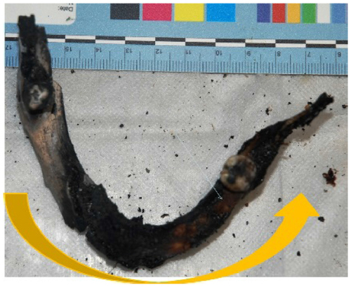 Figure 7 Upper view of the lower jaw with color alteration of bone caused by the fire.