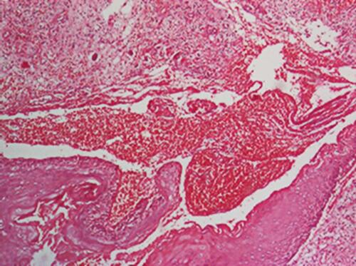 Figure 11 Thickened epidermis, edema, hemorrhagic exudate, inflammatory polymorphic infiltrate (HE stain, x40).