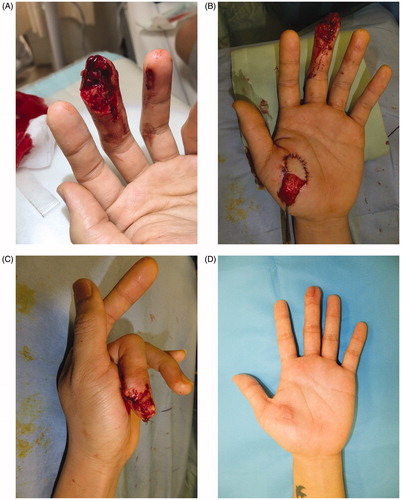 Figure 1. (A) Oblique avulsion of the left middle finger pad. The subcutaneous tissue of the avulsed finger had been intensely crushed, making replantation difficult. (B) Avulsed finger skin grafting to the thenar flap raised site. (C) Suturing of the flap without tension. (D) At 3 months after surgery, there is favorable fingertip form, no contracture in the skin grafted area, and good color/texture match.