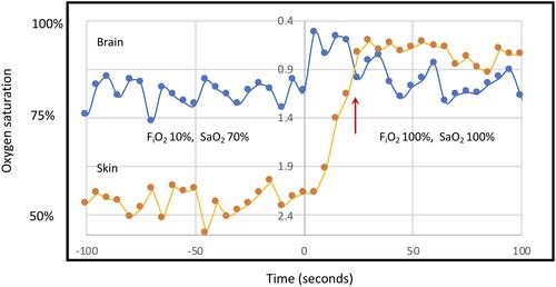 Figure 5 Brain (blue) and Skin (orange) pulse oximeter oxygen saturation levels and modified ratio of ratios (within figure Y axes) following the increase in the inspired oxygen levels (FiO2) from ~10% to 100% at time 0. The targeted arterial oxygen saturations (SaO2) are shown on the figure. Brain oximeter oxygen saturations peaked within 5 seconds of the increase in FiO2, quickly reaching hyperoxic levels and fell thereafter, while skin oxygen levels continued to increase until 25 seconds. The red arrow demonstrates a point at which the direction of change in brain and skin oximeter saturations were opposite. These distinct responses may represent the tight autoregulation of cerebral blood flow to maintain stable brain oxygen saturations. These findings suggest the brain oximeter is not significantly influenced by skin oxygen levels. The oxygen saturation represents the average level over the entire cardiac cycle. Pooled data of 3 subjects, (volunteers 1, 2 and 6).