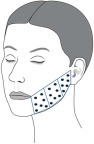 Figure 1 Treatment area and injection points for the left lower cheek. An identical injection pattern was used on the opposite cheek.