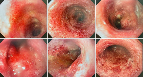 Figure 1 Colonoscopy images showing transverse, descending, sigmoid, and rectum with enanthema, friability, fibrin-covered erosion, and spontaneous bleeding, consistent with colitis in severe endoscopic activity, which is representative of endoscopic Mayo score 3.