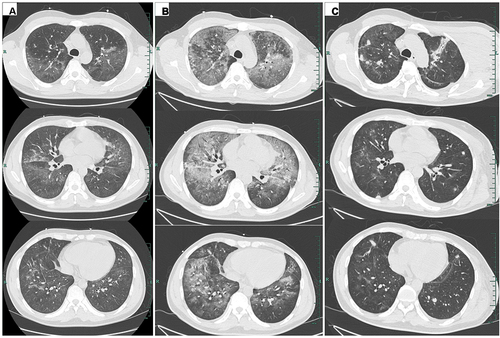 Figure 1 Serial chest CT scans at D1, D10, and D30 during the anti-infection period: (A) the initial CT scan at D1 showed an increased texture of both lungs increased, with multiple slight exudations and a small pleural effusion; (B) CT scan on D10 after admission revealed multiple progressive patchy shadows on both lungs, with ground-glass opacities and inflammatory exudates; (C) the follow-up CT scan on D30 after admission showed resolution of the bilateral diffuse patchy shadows, and increased multiple nodules increased in both lungs, with no pleural effusion. CT, computed tomography.