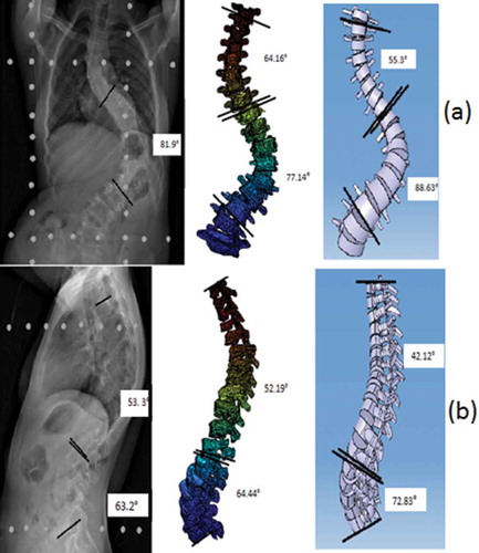 Figure 8. Spinal curvature of subject-2 using both the models (a) Frontal plane (b) Lateral plane.