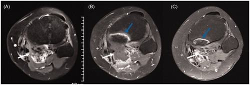Figure 2. Contrast-enhanced axial MRI obtained from a 26-year-old woman with recurrent DT in the popliteal fossa before and after HIFU ablation. (A) Before HIFU ablation, the DT showed significant enhancement (white arrow), and the tibia showed no abnormal signal. (B) Three months after HIFU ablation, the DT without enhancement shrank (white arrow), and the tibia adjacent to the DT showed banded hyperintensity (blue arrow). (C) Fifteen months after HIFU ablation, the DT disappeared (white arrow), and the area of hyperintensity in the tibia (blue arrow) shrank.