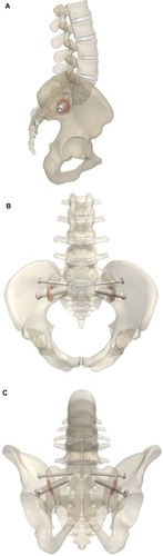 Figure 2 Schematic representation of the implanted SImmetry SI Joint Fusion System in (A) lateral, (B) inlet, and (C) outlet views.