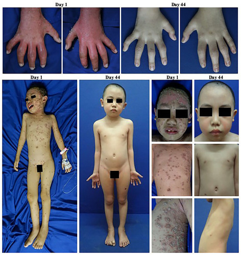 Figure 4 Clinical manifestation of OP and PA before and after treatment. Significant improvements on joints involved and the skin lesions occurred on day 44 of observation, with reduced pain and swelling on the joints involved as well as resolution of skin lesions.