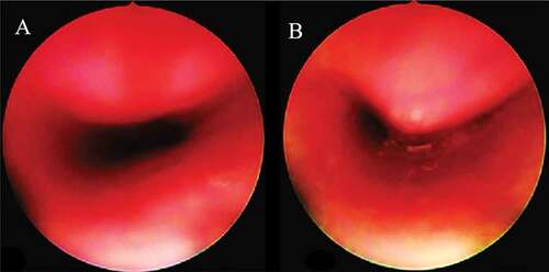 Figure 2. Bronchoscopic findings in severe tracheomalacia. (a): during inspiration, the trachea remains patent, (b): during expiration, the trachea collapses on itself