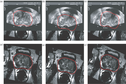 Figure 6. Motion compensation using 2.5D/3D registration. The red contours show the prostate segmentation in the MRI image. The 3D MRI volume is pre-registered to a 3D ultrasound volume that is not shown. Top row: RTUS overlaid on MRI. Bottom row: MRI images. (a) and (a′) are the initial registration without patient motion; (b) and (b′) are the deteriorated registration after patient motion; and (c) and (c′) are the registration after motion compensation. [Color version available online.]