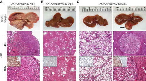 Figure 2. Genetic depletion of ChREBP strongly delays hepatocarcinogenesis driven by AKT overexpression in the mouse. (a) Overexpression of myr-AKT1 promoted the development of multiple liver tumors by 29 weeks post hydrodynamic injection in ChREBP WT mice (indicated as AKT/ChREBP). Macroscopically, livers of AKT/ChREBP mice were enlarged, pale, and characterized by the presence of numerous nodules occupying the whole surface. Microscopically, the liver parenchyma of AKT/ChREBP mice was occupied by large hepatocellular tumors containing areas of necrosis (N). Importantly, tumors displayed a homogeneous immunoreactivity for HA-tagged AKT (insets), implying their origin from hydrodynamically transfected cells. (a; lower panel). (b) In striking contrast, overexpression of AKT in ChREBP KO mice (indicated as AKT/ChREBPKO) resulted in delayed hepatocarcinogenesis at the same time point. Livers of AKT/ChREBKO mice appeared normal macroscopically and displayed the presence of isolated or small clusters of altered cells at the microscopic level. As expected, the scattered altered hepatocytes exhibited immunolabeling for HA-Tagged AKT (inset). (c; left panels). Fifty-two weeks after hydrodynamic injection, a large fraction of AKT/ChREBPKO liver parenchyma was occupied by altered hepatocytes, characterized by a strikingly enlarged cytoplasm. (c; right panels). Furthermore, the liver of three of fifteen (20%) AKT/ChREBPKO mice displayed the presence of tumor nodules macroscopically appreciable (indicated by arrow). Microscopically, the nodular lesions consisted of clear-cell hepatocellular carcinomas. Original magnifications: 40x and 100x. Scale bar: 500µm for 40x, 100µm for 100x. Abbreviations: HE, hematoxylin and eosin; w.p.i., weeks post injection.